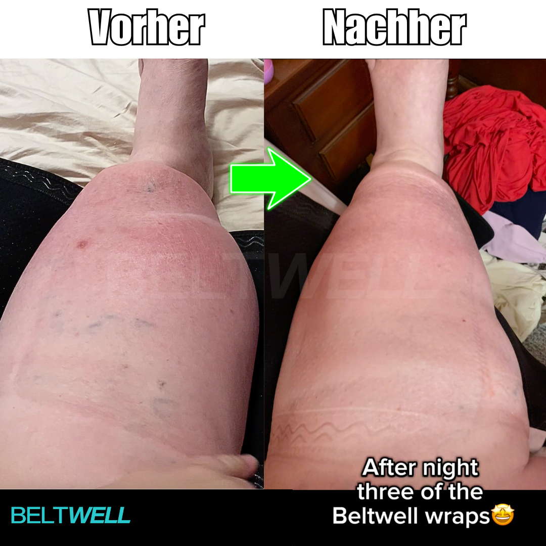 Beltwell® Waden-Kompressionsbandage