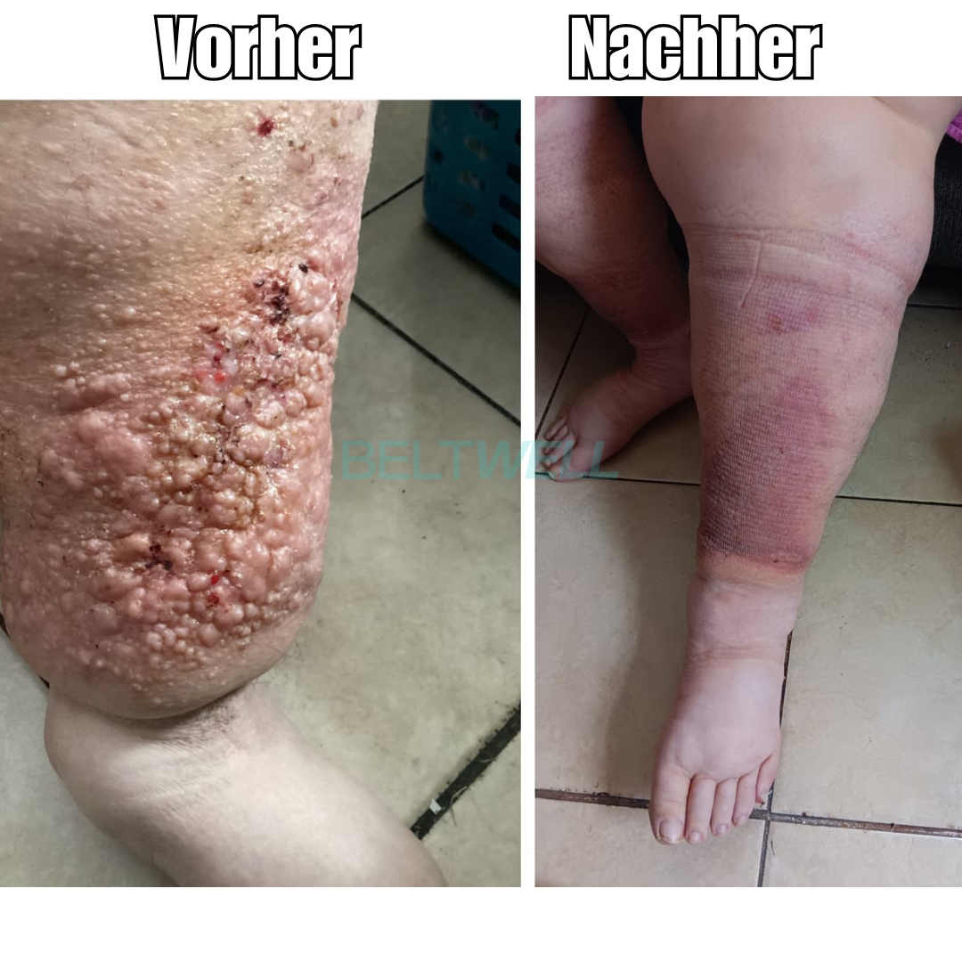 Beltwell® Waden-Kompressionsbandage