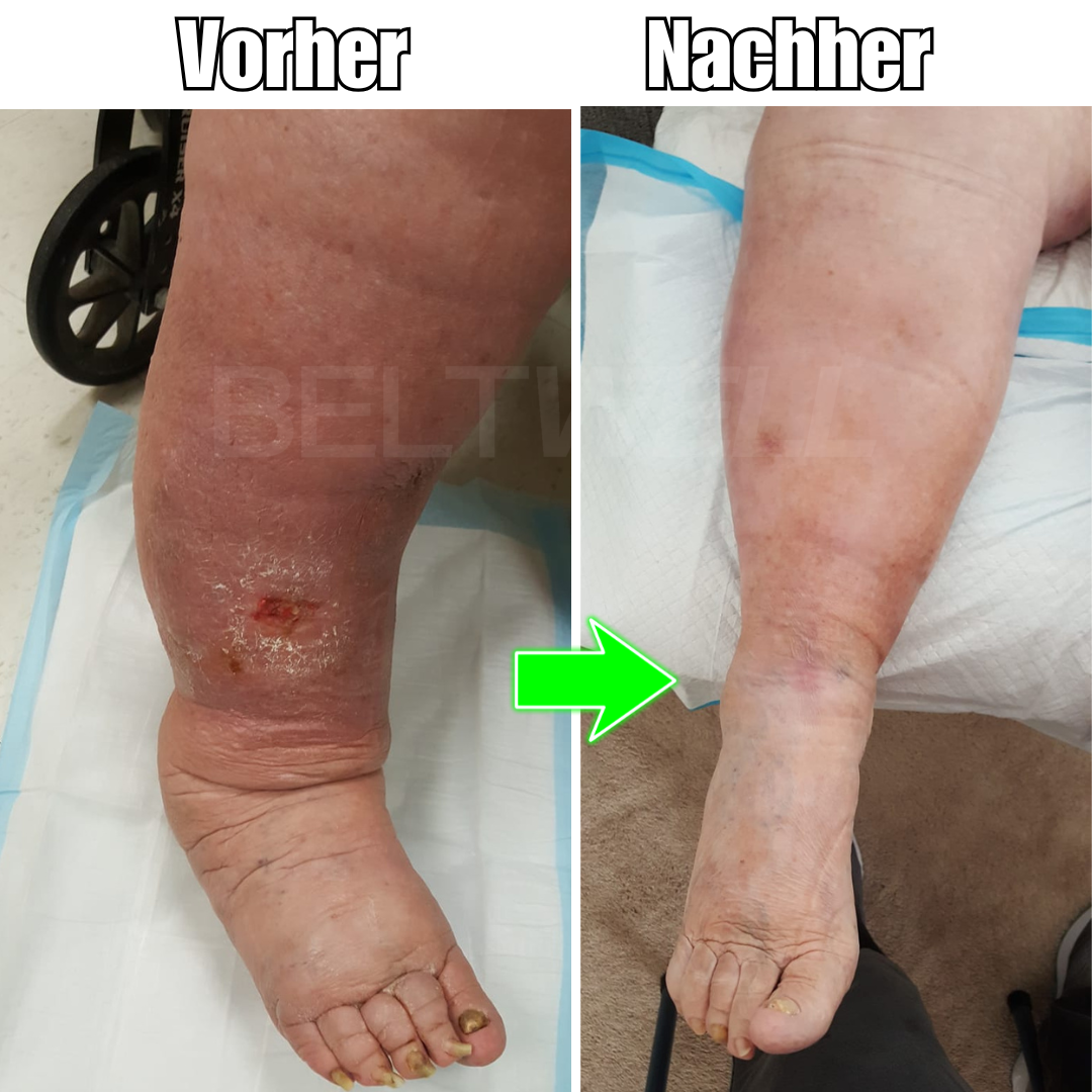 Beltwell® Waden-Kompressionsbandage